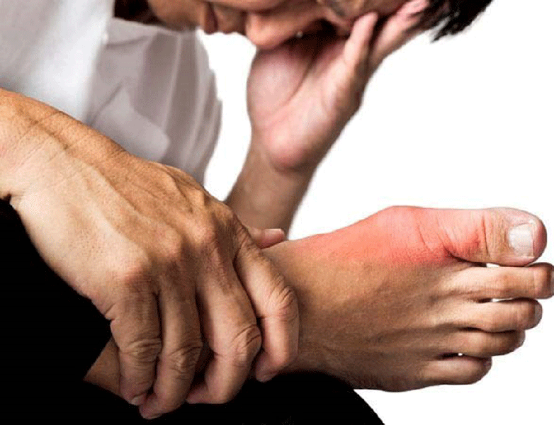 Gout (gút): Nguyên nhân, triệu chứng, chẩn đoán và điều trị
